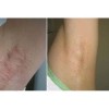 潍坊专业疤痕修复-潍坊专业疤痕修复治疗方法